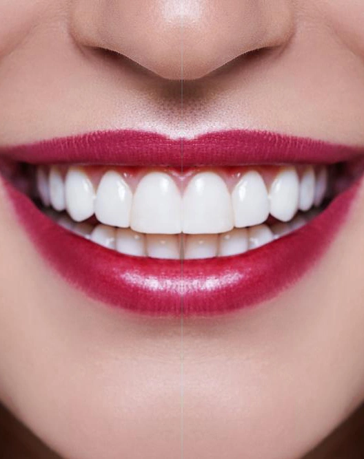 teeth01